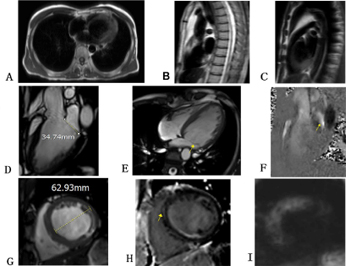 Cardiovascular Disease and Atherosclerosis id1043